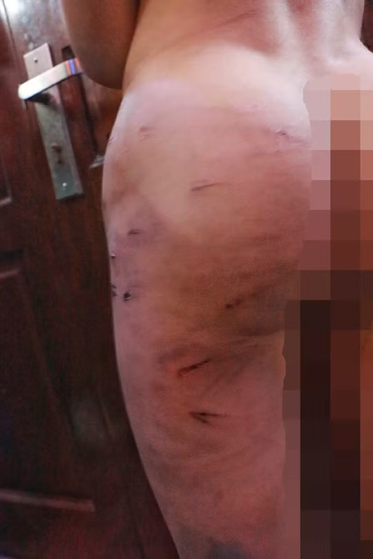 Những vết thương chi chít trên người cháu Nguyên nghi do bố ruột bạo hành bằng dây điện