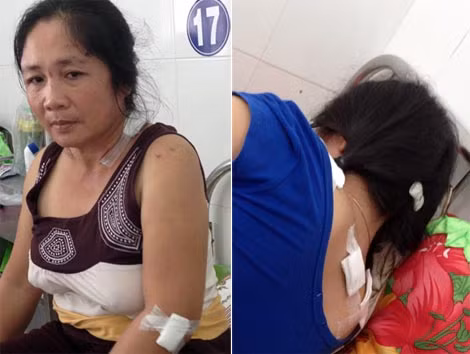Bà Tâm với các vết thương trên người, chị Duyên vẫn còn khá đau sau khi bị đâm.