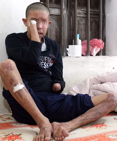 Tai nạn đã cướp đi đôi mắt và hai bàn tay của anh Hảo. Tai nạn đã cướp đi đôi mắt và hai bàn tay của anh Hảo.