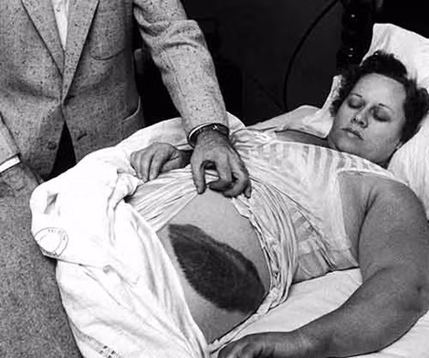 Bà Ann Elizabeth Hodges (1923 - 1972), người duy nhất thế giới bị thiên thạch đập trúng ngay trong ngôi nhà thuê ở Sylacauga, tiểu bang Alabama (Mỹ) vào cuối năm 1954.