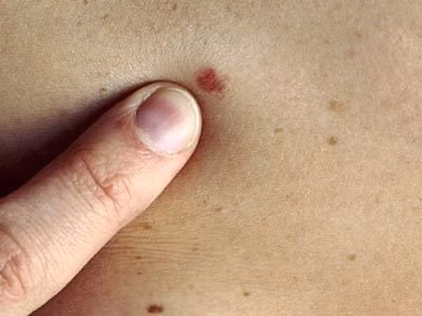 Tự dưng da xuất hiện mụn cóc? Không phải dạng vừa đâu!