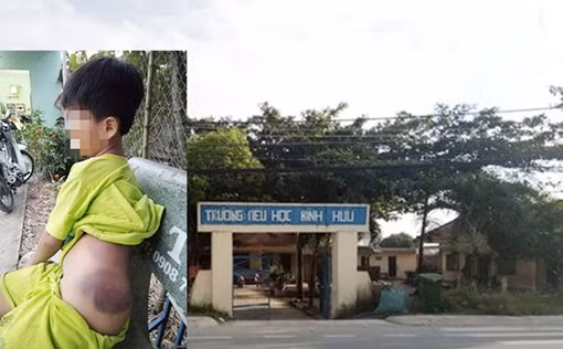 Đình chỉ công tác 15 ngày đối với giáo viên đánh học sinh lớp 1 bầm tím người