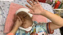 Bé gái 9 tuổi bị tay phanh xe đâm vào ổ mắt trái và nhu mô não