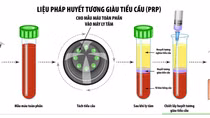 Bệnh viện 30-4 dùng huyết tương giàu tiểu cầu điều trị bệnh