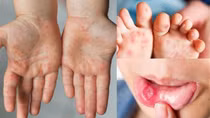 Đã có thuốc điều trị bệnh tay chân miệng nặng