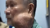 Suýt mất mạng vì mang khối u khổng lồ 30 năm không điều trị