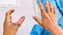 Nối thành công ngón tay bị đứt lìa do tai nạn lao động