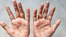 Chủ động tìm nguồn vaccine, thuốc điều trị khi có ca bệnh đậu mùa khỉ xâm nhập