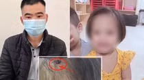 Hà Nội yêu cầu xử lý nghiêm vụ cháu bé bị đóng đinh vào đầu