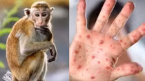 Bộ Y tế đưa đậu mùa khỉ vào danh mục bệnh truyền nhiễm nhóm B