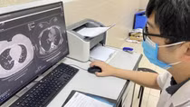 Nhiều bệnh nhân hậu COVID-19 bị hoại tử, tiêu xương vùng mặt