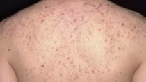 Suýt tử vong vì trị mụn trứng cá ở lưng tại một spa