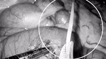 Xương cá hơn 2,5cm đâm xuyên thủng ruột non một phụ nữ