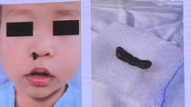 Hi hữu: Vắt làm tổ trong mũi bé trai, miếng sắt găm sâu trong hốc mắt thợ cơ khí