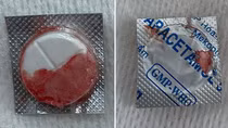 Gắp thành công viên thuốc nguyên vỏ trong thực quản cho bé trai
