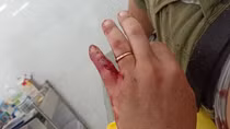 Người dân bị khỉ hoang tấn công thương tích nặng