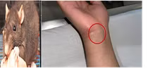 Mắc bệnh nguy hiểm sau khi bị chuột cắn