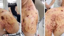 Bó lá điều trị gãy xương đòn, người phụ nữ ở Hà Nội bị bỏng da và nhiễm trùng nặng