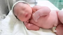 Bé gái chào đời cùng vòng tránh thai của mẹ