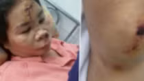 Xác minh thông tin vụ cướp giật khiến người phụ nữ bị chấn thương sọ não