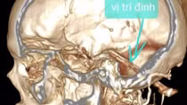 Cây đinh dài 7cm nằm trong đầu cả năm mà không biết