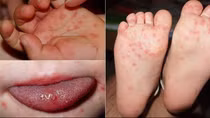 Thêm nhiều ổ dịch tay chân miệng xuất hiện ở Hà Nội
