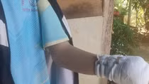 Chơi pháo, nam sinh mất cả bàn tay