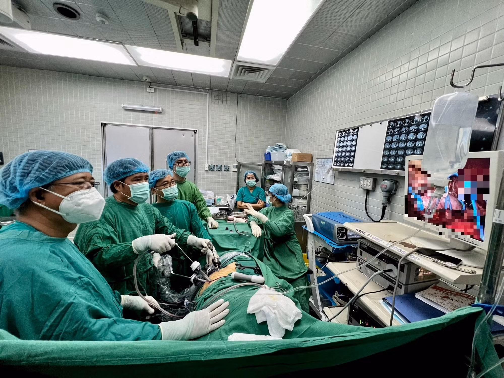 Lần đầu tiên phẫu thuật nội soi cho bệnh nhân ung thư thận có chồi bướu trong tĩnh mạch chủ -0