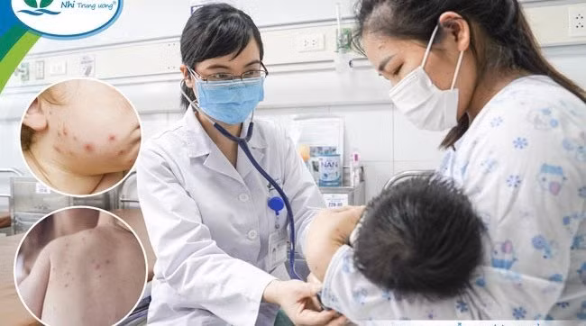 Trẻ sơ sinh bị thuỷ đậu biến chứng viêm phổi, suy hô hấp, cha mẹ không được chủ quan -0
