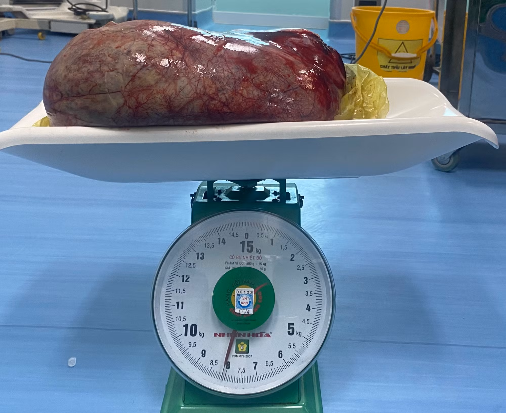 Phẫu thuật lấy khối u buồng trứng nặng 8.1 kg cho cụ bà 83 tuổi -1