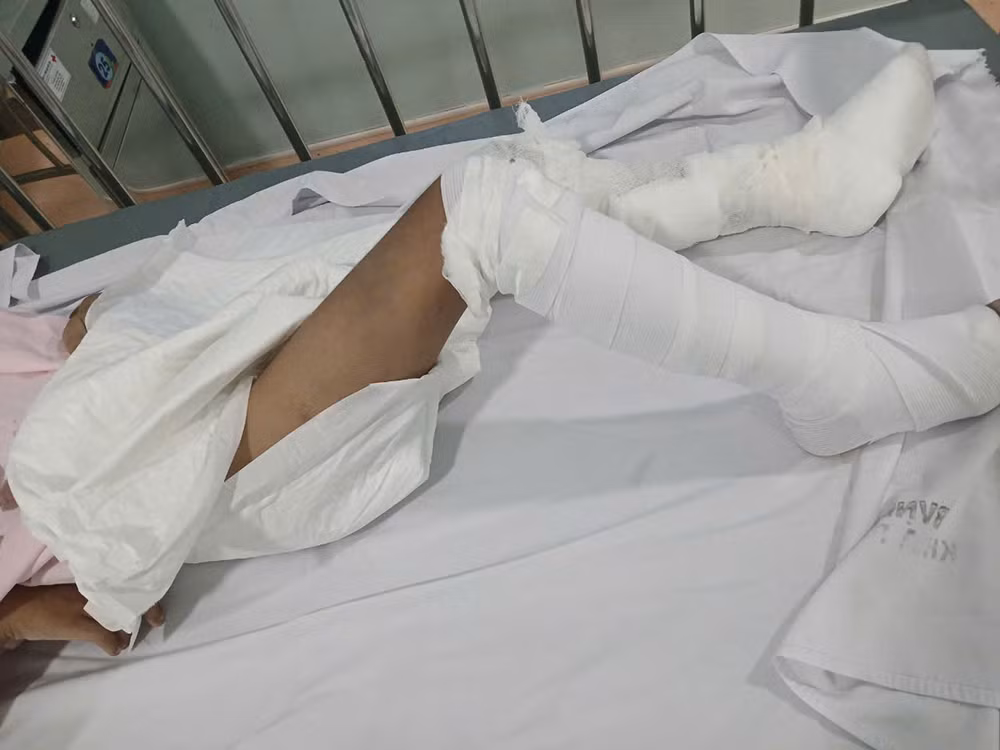 Bé trai 6 tuổi nghi bị bỏng nặng do bị tạt nước sôi -0