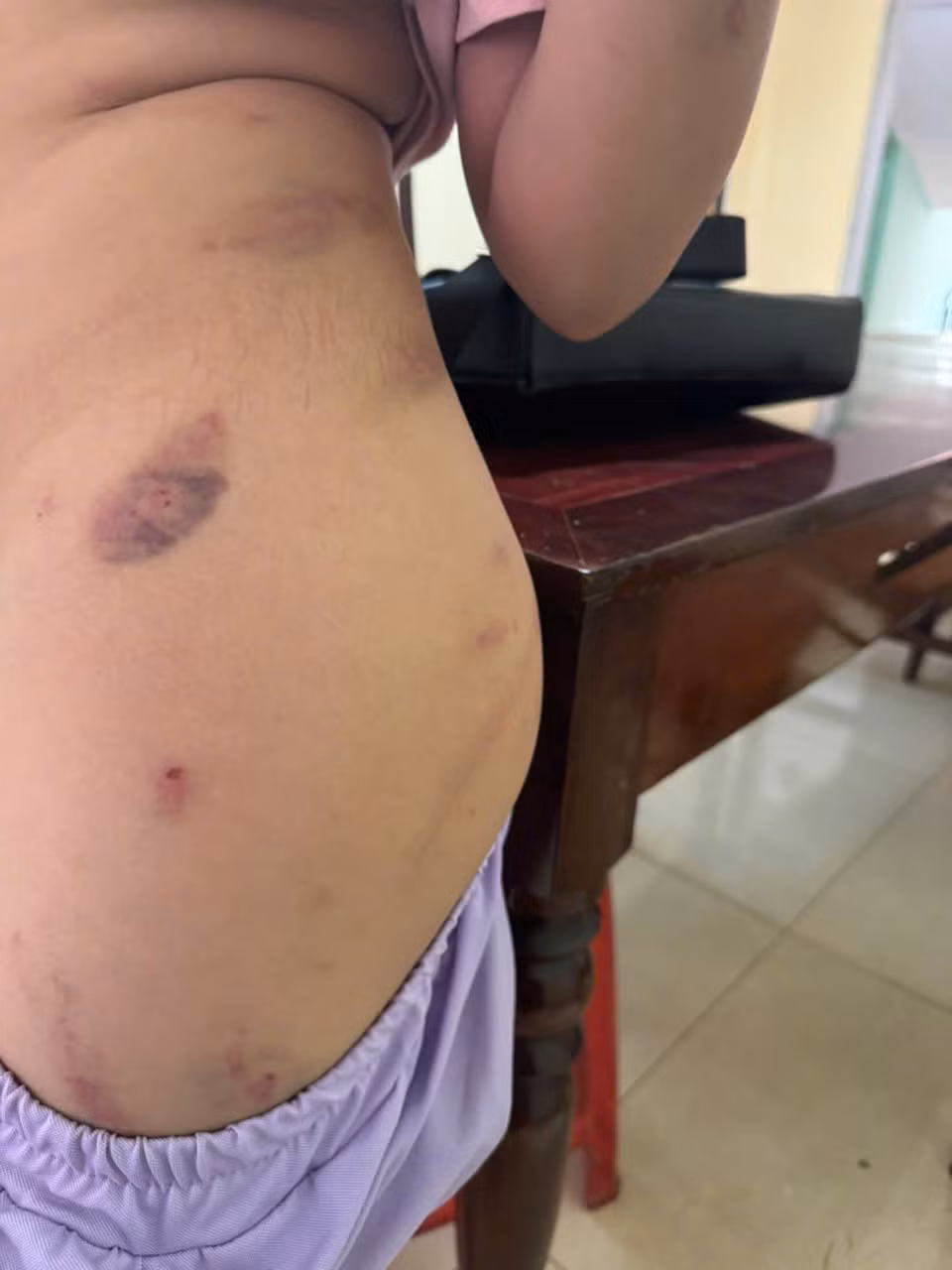 Công an xác minh điều tra vụ bé gái 9 tuổi bị đánh chi chít vết thương trên người -0