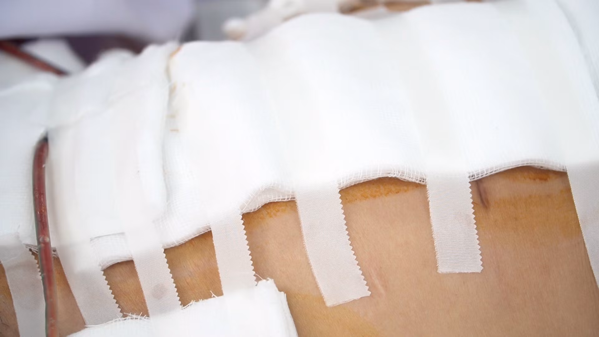 Đi hút mỡ bụng, người phụ nữ bị thủng bụng, mất 6 lít máu, rơi vào hôn mê -0
