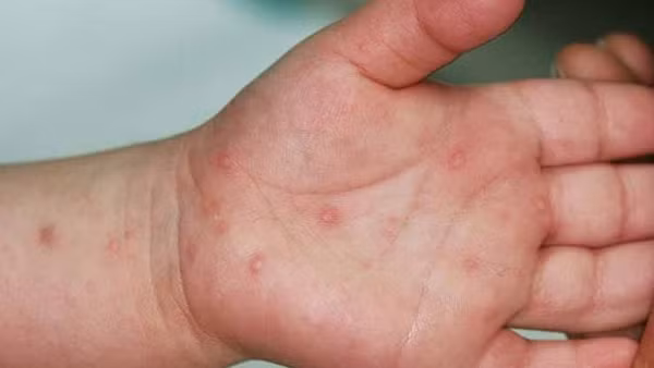 Thiếu thuốc điều trị bệnh tay chân miệng mức độ nặng, Bộ Y tế nói gì?