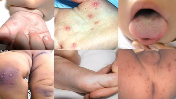 Cảnh báo dịch chồng dịch – tay chân miệng và sốt xuất huyết