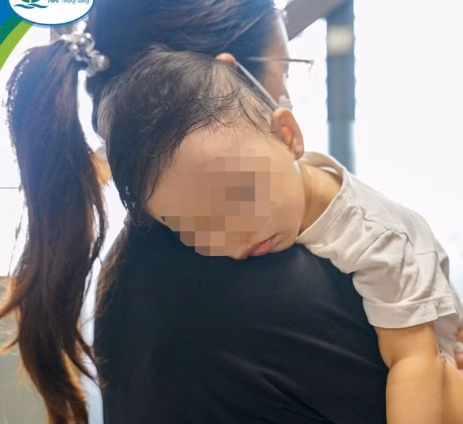 Bé gái 13 tháng tuổi bị dây thép đâm xuyên qua Amidan -0