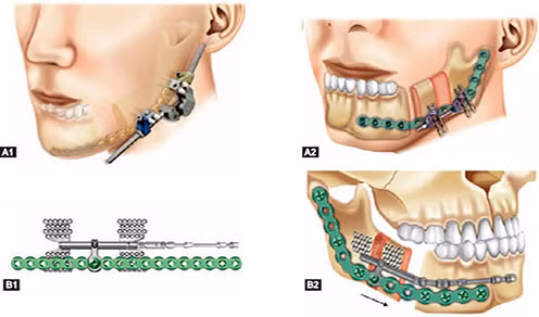 Mang lại gương mặt mới cho nam sinh không có xương gò má -0