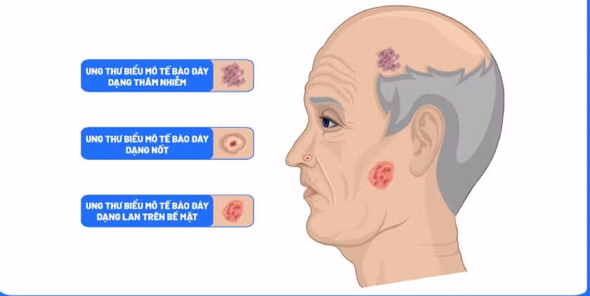 Nắng nóng cẩn trọng với căn bệnh ung thư da -0