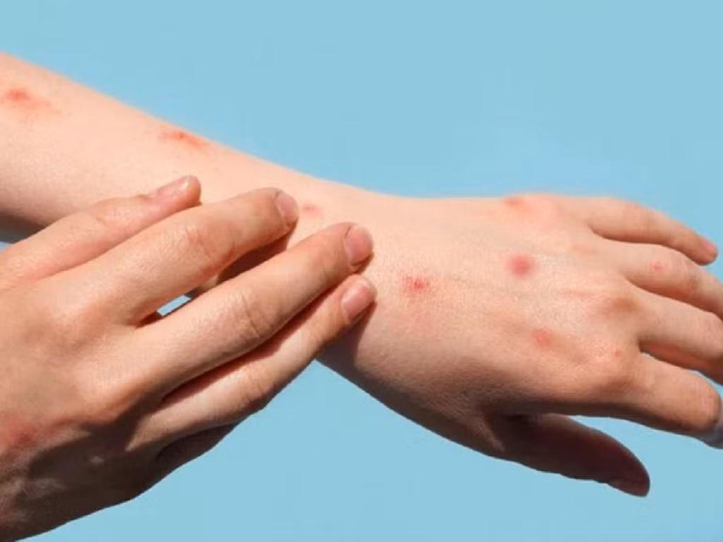 Tăng cường kiểm soát, phòng, chống bệnh đậu mùa khỉ -0