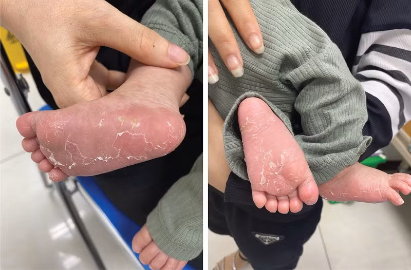 Bất ngờ bé trai 40 ngày tuổi mắc bệnh giang mai bẩm sinh -0