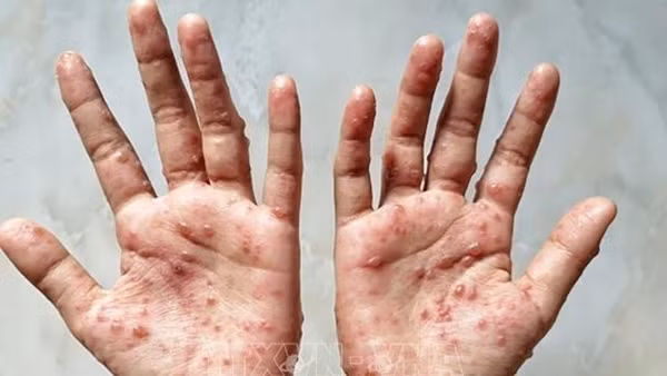 Chủ động tìm nguồn vaccine, thuốc điều trị khi có ca bệnh đậu mùa khỉ xâm nhập