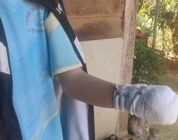Chơi pháo, nam sinh mất cả bàn tay -0