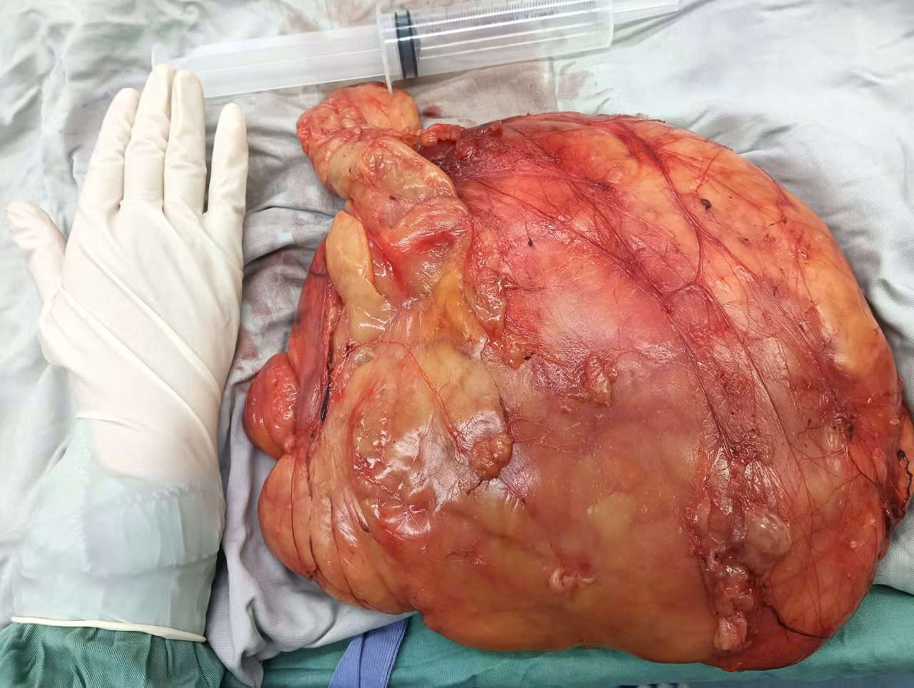 Cứu thành công một người đàn ông bụng mang “khối u” 5kg -0
