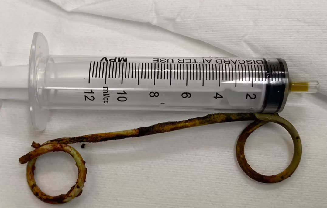 Ống stent bị bỏ quên 6 năm trong túi mật cụ bà 77 tuổi -0