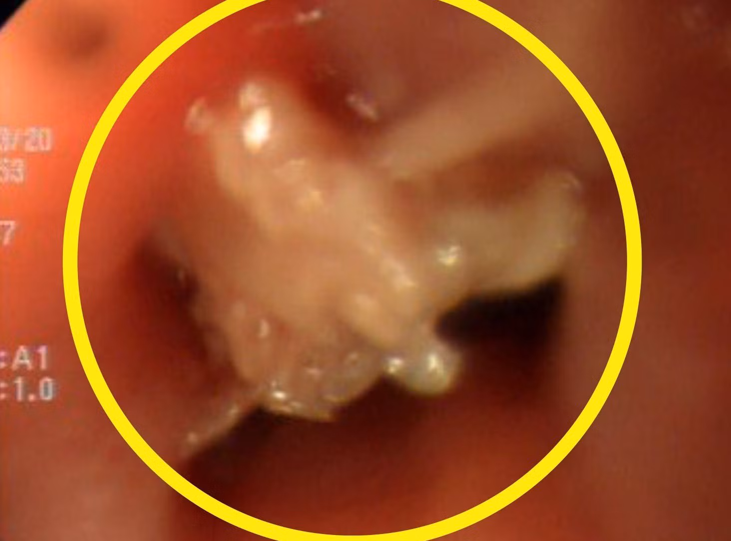Xương cá đâm thủng thực quản do tự chữa mẹo dân gian -0