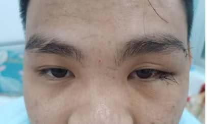 Cứu chữa thành công mắt trái của chàng trai bị kẻ nghi ngáo đá đâm xuyên hốc mắt -1