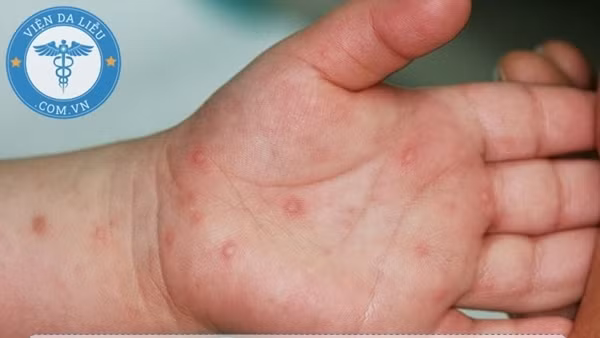 Tăng cường phòng chống bệnh tay chân miệng khi đã có trẻ tử vong