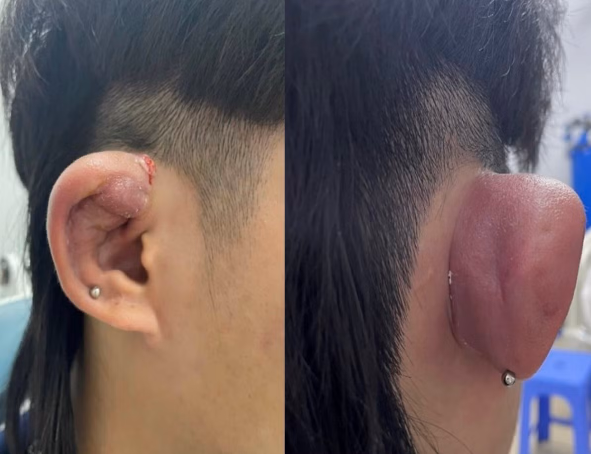 Hoại tử tai vì mốt bấm nhiều khuyên của giới trẻ -0