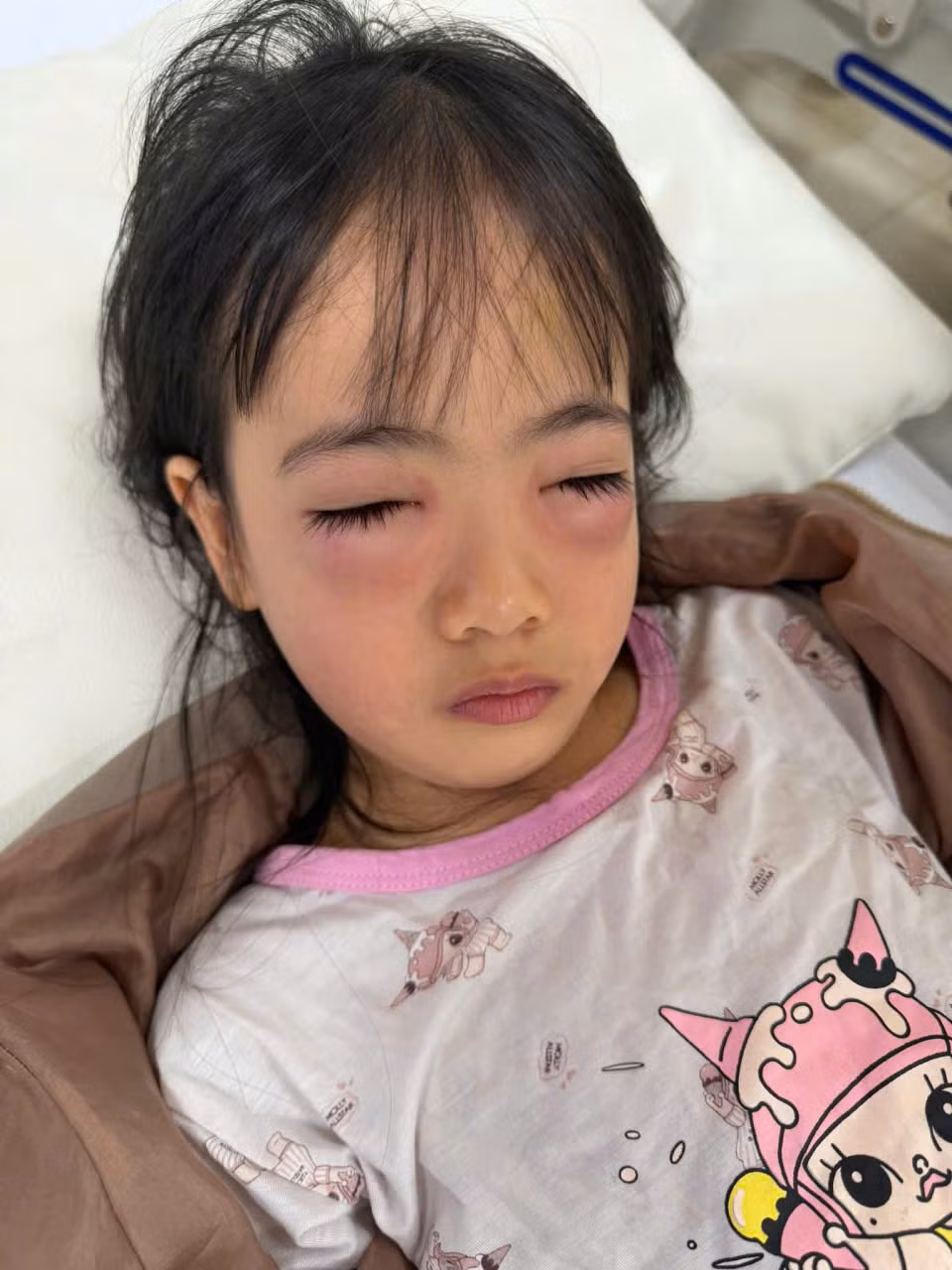 Bé gái 5 tuổi bị viêm mạc di ứng sau khi chơi thổi bong bóng xà phòng -0