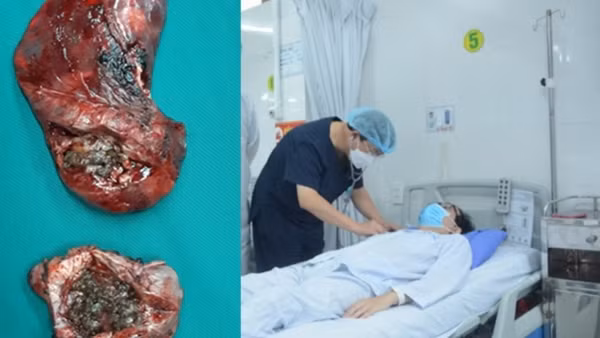 Cắt bỏ khối u “khủng” gần 6kg ảnh 2